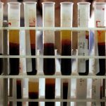 trasfusioni infette