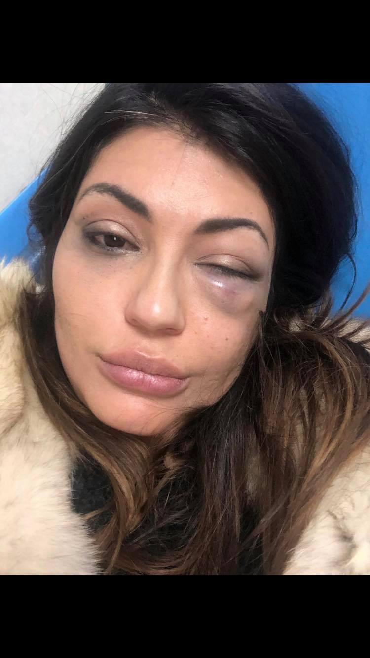 Vanesa Rodriguez, dopo l'aggressione subita il 21 gennaio 2019 al ristorante "Veneziano" a Formia