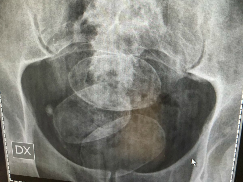 Ovuli di eroina scoperto da un accertamento radiologico (foto di archivio)